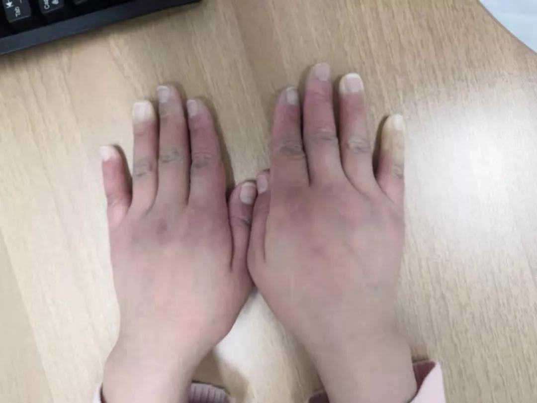 “手指、腳趾發(fā)白、發(fā)紫……”這些“小毛病”千萬(wàn)別大意