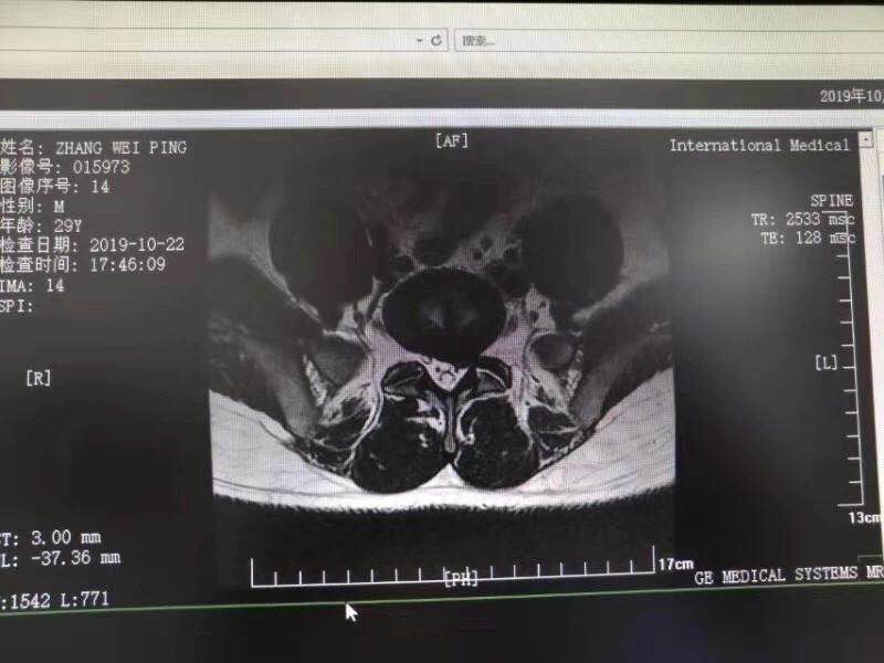 西安國(guó)際醫(yī)學(xué)中心骨科醫(yī)院成功完成首臺(tái)椎間孔鏡手術(shù)