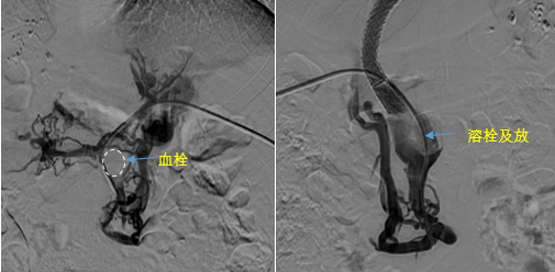 血栓攔路，如何破局——罕見巨大門靜脈血栓TIPS手術(shù)實錄