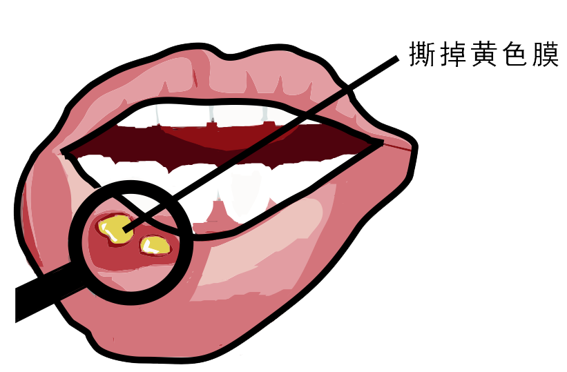 經(jīng)?？谇粷?，真的只是缺維生素嗎？