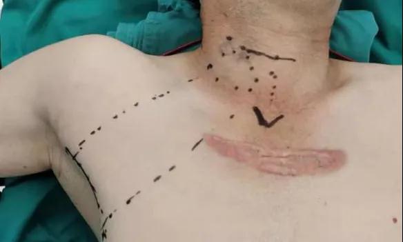 術后傷口可以“隱身”嗎？