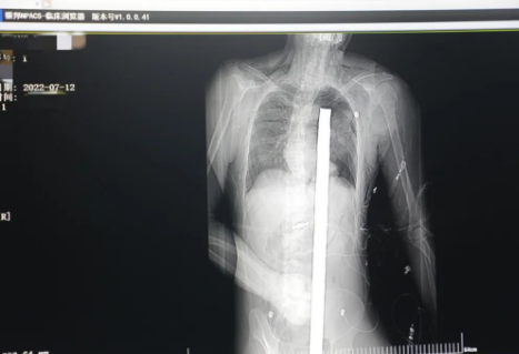 1.2米長(zhǎng)的鋼筋貫穿男子胸腹！情況極度危險(xiǎn)......