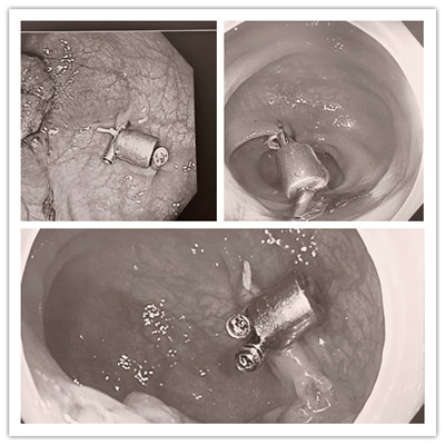 消化病醫(yī)院內(nèi)外科聯(lián)合開(kāi)展3例“磁環(huán)預(yù)標(biāo)記輔助腹腔鏡結(jié)、直腸癌根治術(shù)”