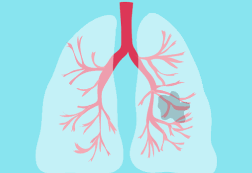 肺結節(jié)“知多少”