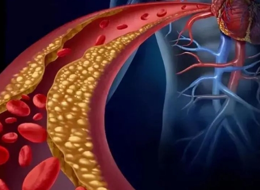 警惕！冠脈支架術(shù)后這些誤區(qū)千萬別踩，趕緊收藏！