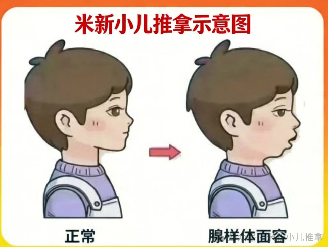 兒童腺樣體肥大只能手術(shù)？不，一位媽媽的親身經(jīng)歷給出另一種答案